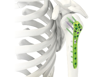 Proximal Humerus Plating System